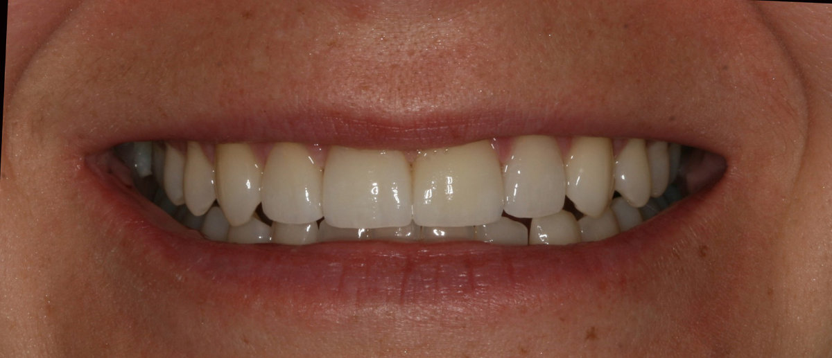 A patient after cosmetic dental veneers placement