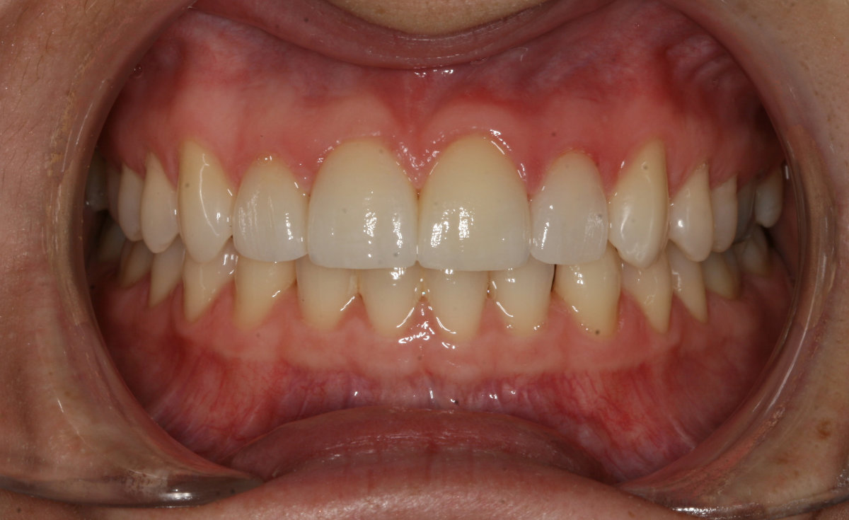 A patient after cosmetic dental veneers placement