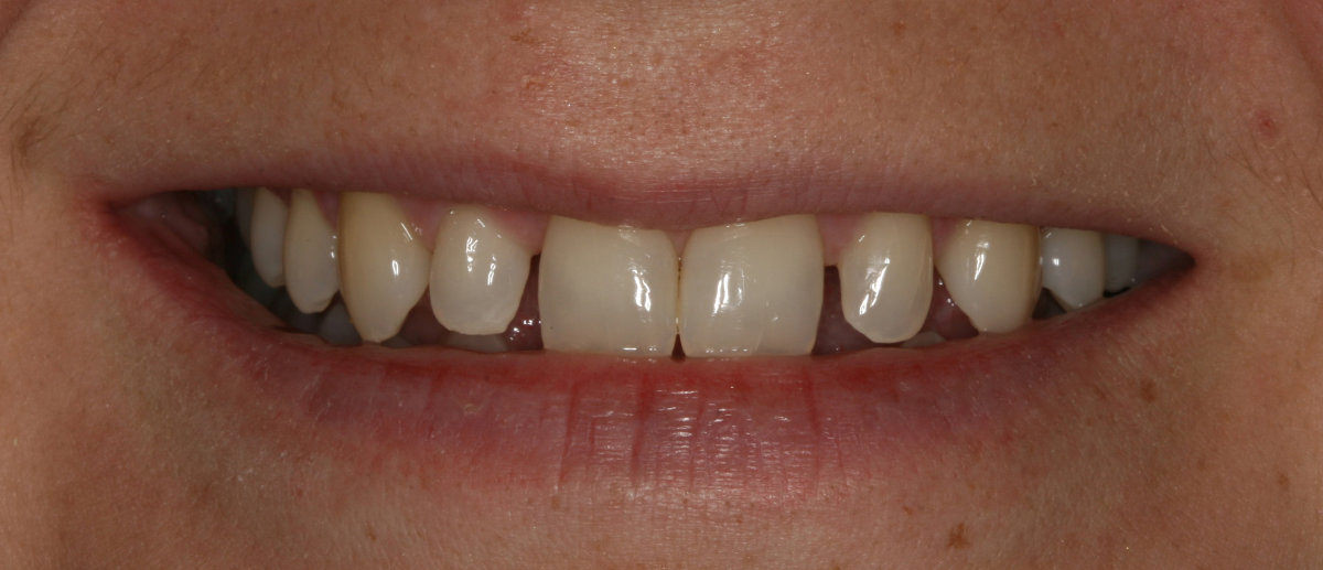 A patient before cosmetic dental veneers placement