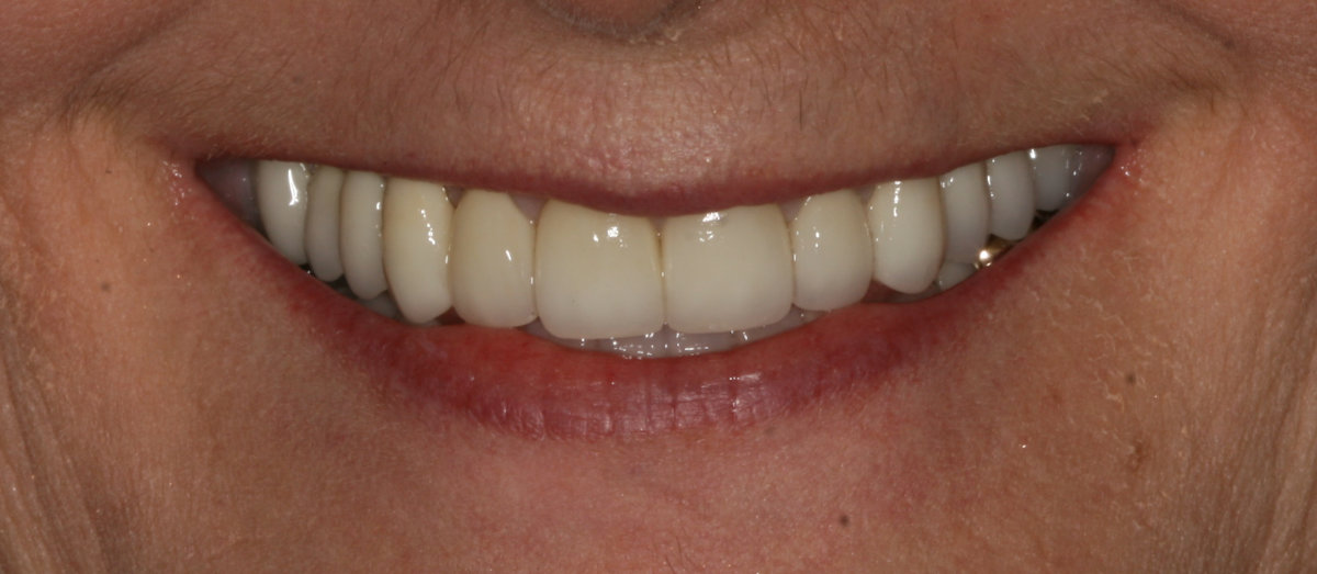 A patient after cosmetic teeth restoration treatment