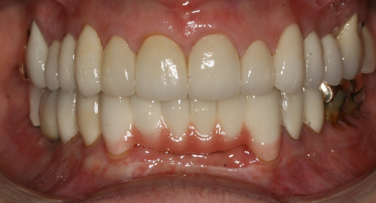 A patient after cosmetic teeth restoration treatment