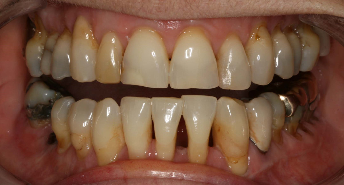 A patient before cosmetic teeth restoration treatment