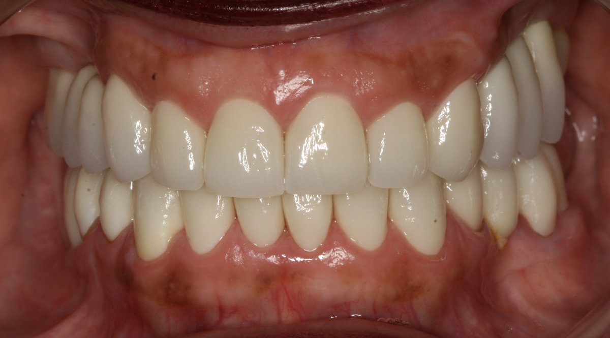 Patient's teeth after cosmetic teeth restoration treatment
