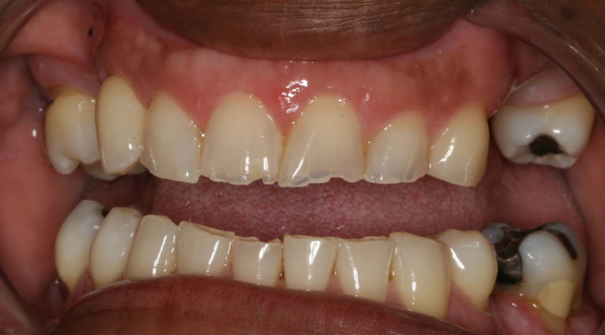 Patient's teeth before cosmetic teeth restoration treatment
