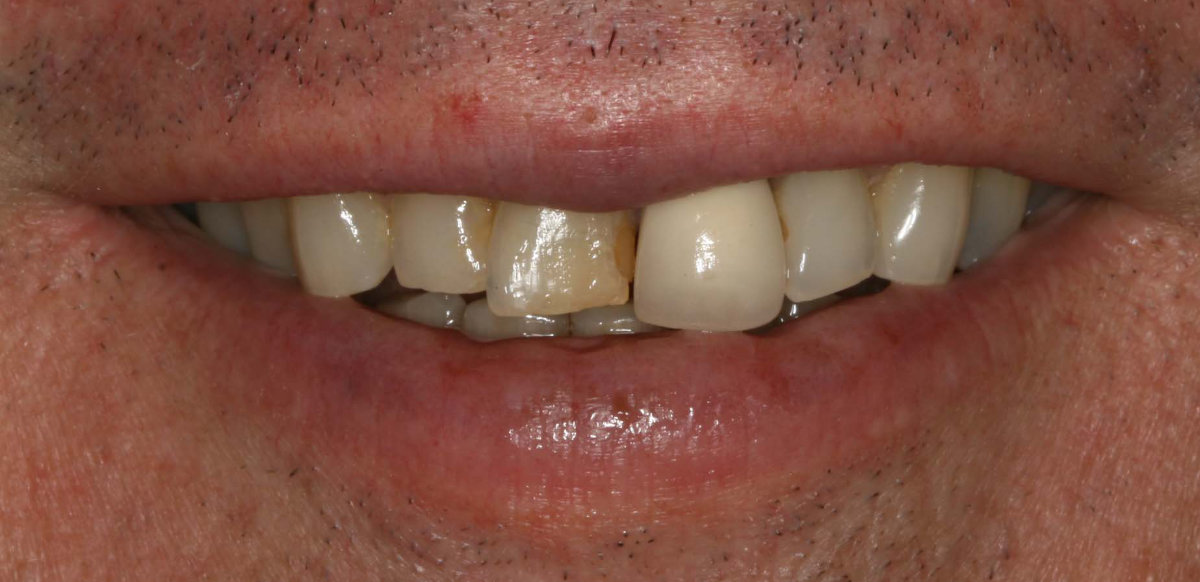 Patient's teeth before crowns across upper anterior teeth placem