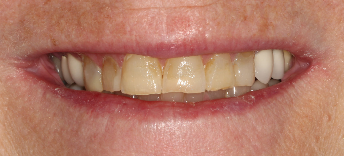 A patient before cosmetic teeth restoration treatment