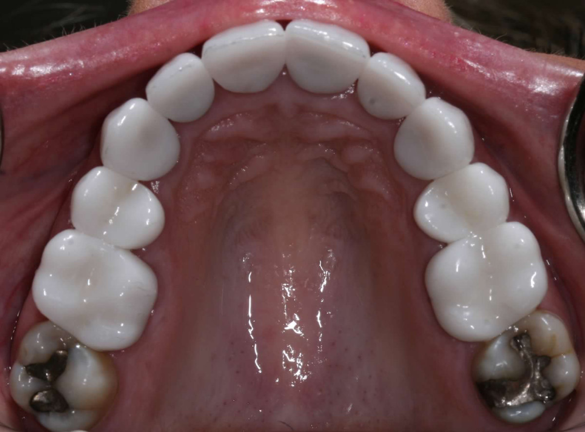 A patient after crowns across upper and lower anteriors placement