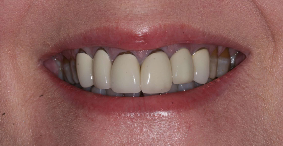 A patient before crowns across upper and lower anteriors placement