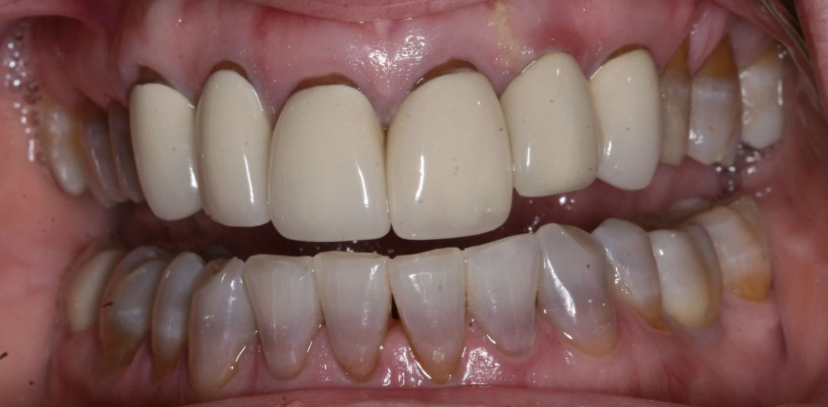 A patient before crowns across upper and lower anteriors placement