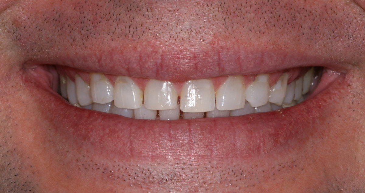 A patient before crowns across upper anterior teeth placement