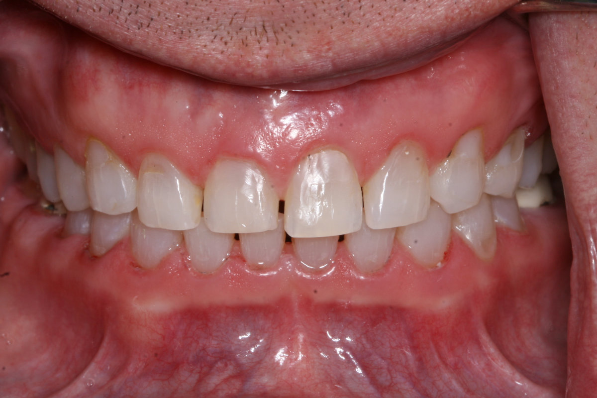 A patient before crowns across upper anterior teeth placement