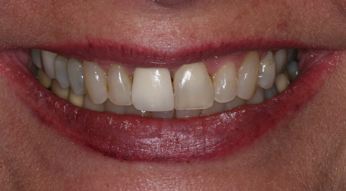 A patient before dental crowns placement