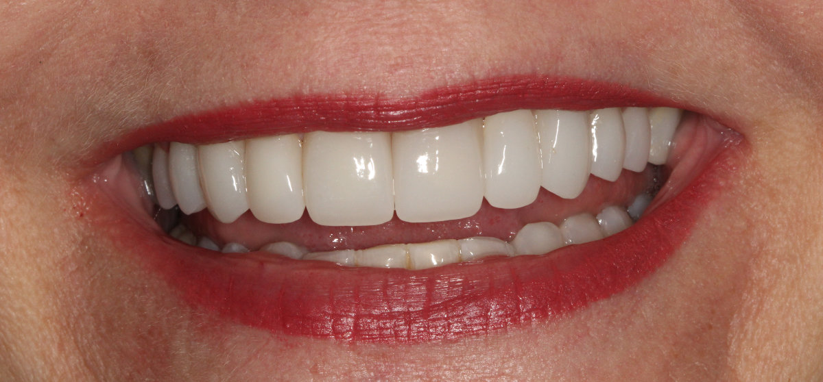 A patient after crowns across upper anterior teeth placement