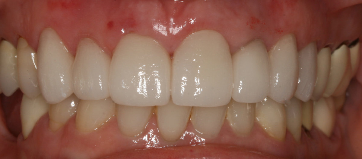 A patient after dental crowns placement
