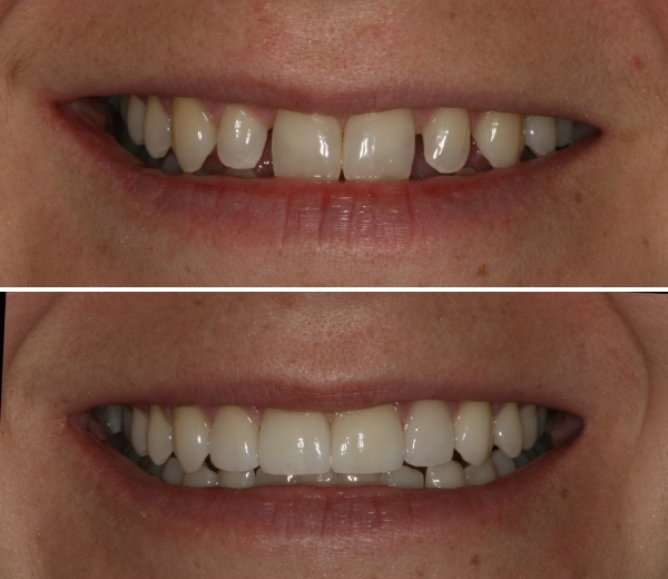 A before and after patient's photo crowns across upper anterior teeth placement