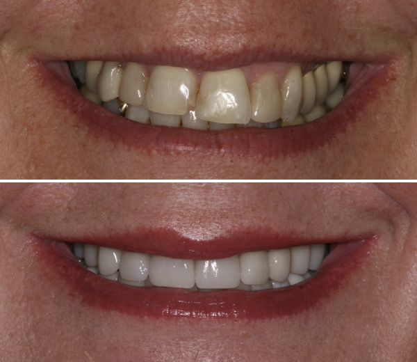 A before and after patient's photo crowns across upper anterior teeth placement